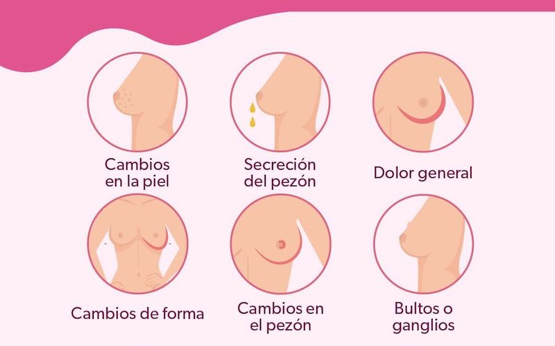 Cáncer de mama